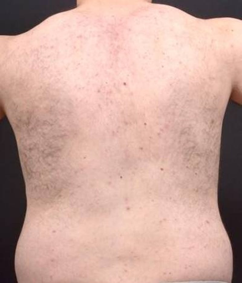 Abdominoplasty Before & After Gallery - Patient 384285 - Image 11