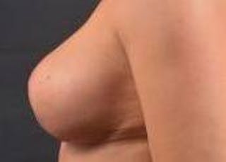 Aesthetic Breast Revision Before & After Gallery - Patient 178104 - Image 4
