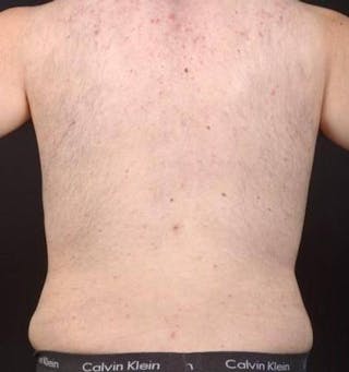 Abdominoplasty Before & After Gallery - Patient 384285 - Image 12