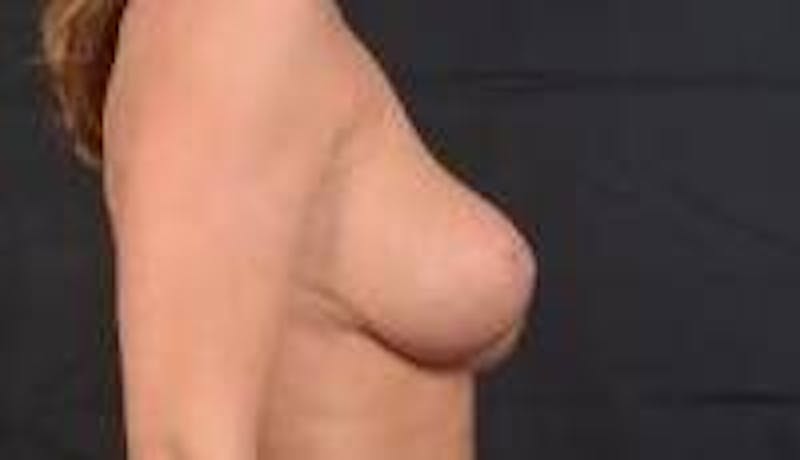 Aesthetic Breast Revision Before & After Gallery - Patient 178104 - Image 5