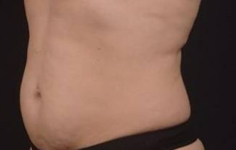 Abdominoplasty Before & After Gallery - Patient 239922 - Image 3