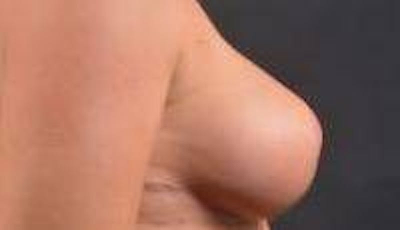 Aesthetic Breast Revision Before & After Gallery - Patient 178104 - Image 6