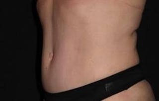 Abdominoplasty Before & After Gallery - Patient 239922 - Image 4