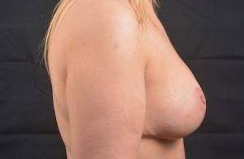 Breast Augmentation Mastopexy Before & After Gallery - Patient 411709 - Image 4