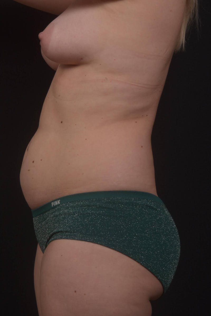 Mommy Makeover Before & After Gallery - Patient 415519 - Image 3