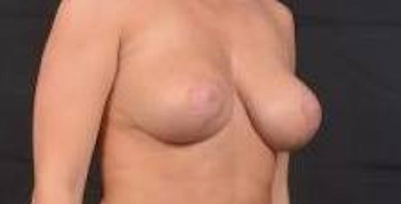 Aesthetic Breast Revision Before & After Gallery - Patient 178104 - Image 9