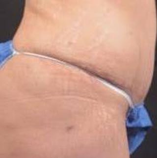 Breast Augmentation Mastopexy Before & After Gallery - Patient 411709 - Image 6