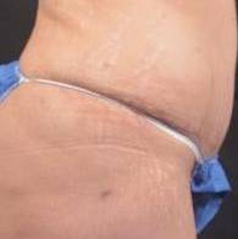 Breast Augmentation Mastopexy Before & After Gallery - Patient 411709 - Image 6