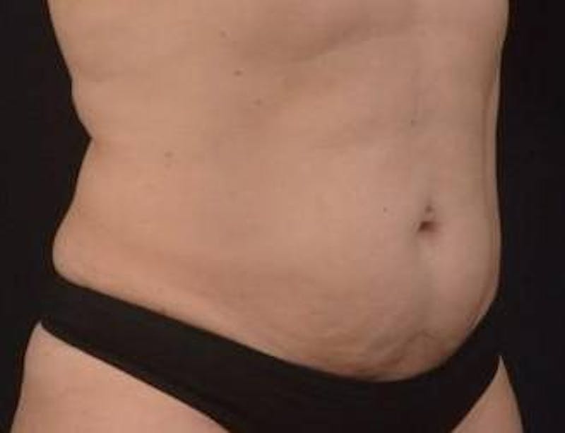 Abdominoplasty Before & After Gallery - Patient 239922 - Image 5