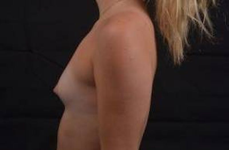 Breast Augmentation Silicone Gel Before & After Gallery - Patient 117081 - Image 3