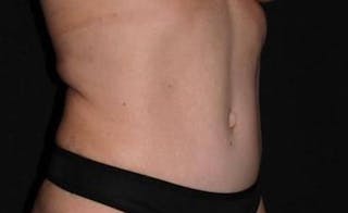 Abdominoplasty Before & After Gallery - Patient 239922 - Image 6