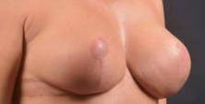 Aesthetic Breast Revision Before & After Gallery - Patient 178104 - Image 10