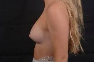 Breast Augmentation Silicone Gel Before & After Gallery - Patient 117081 - Image 4