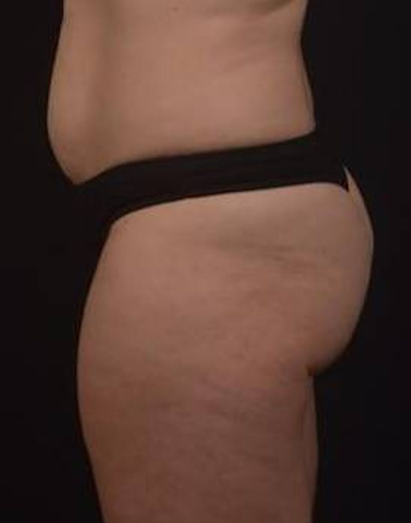Abdominoplasty Before & After Gallery - Patient 239922 - Image 7