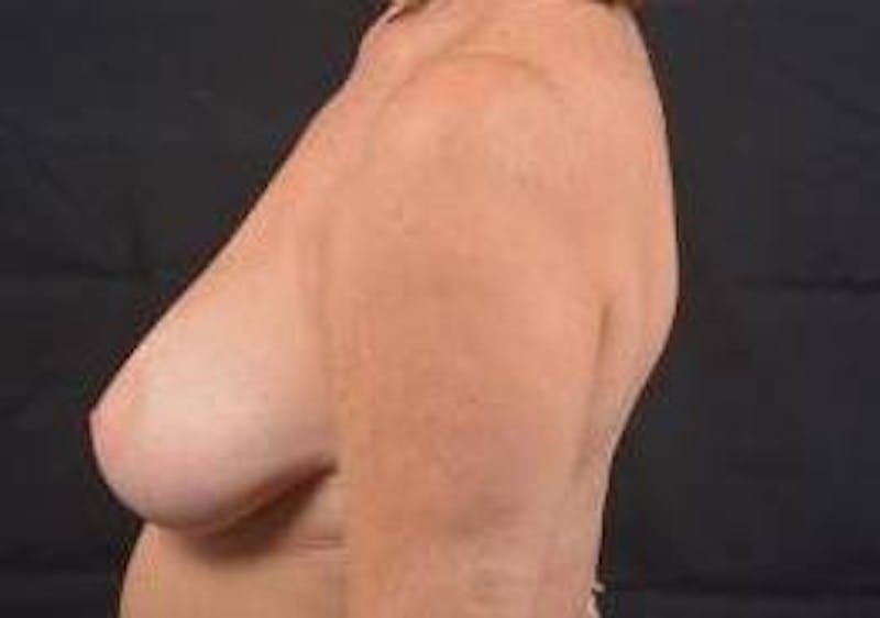 Breast Augmentation Mastopexy Before & After Gallery - Patient 787356 - Image 3
