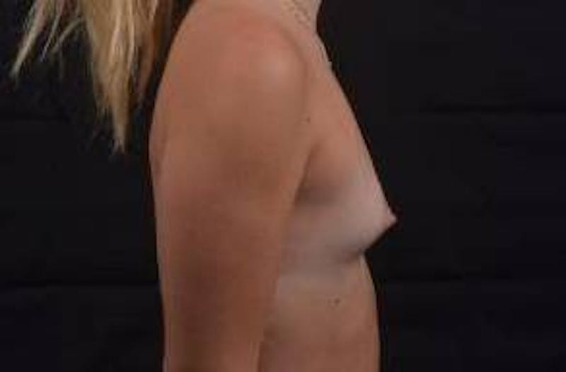 Breast Augmentation Silicone Gel Before & After Gallery - Patient 117081 - Image 5