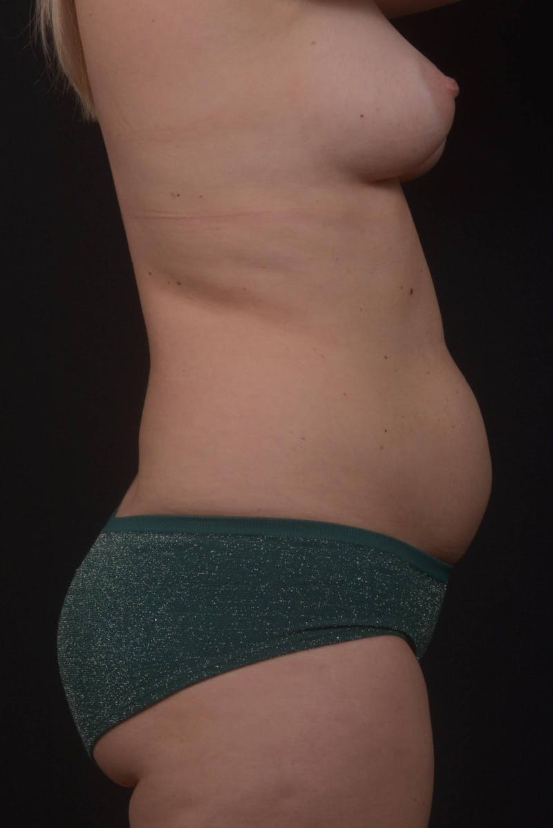 Mommy Makeover Before & After Gallery - Patient 415519 - Image 5