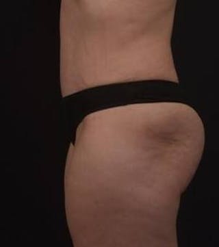 Abdominoplasty Before & After Gallery - Patient 239922 - Image 8