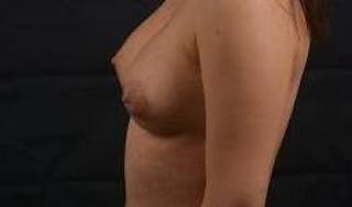 Aesthetic Breast Revision Before & After Gallery - Patient 172483 - Image 4