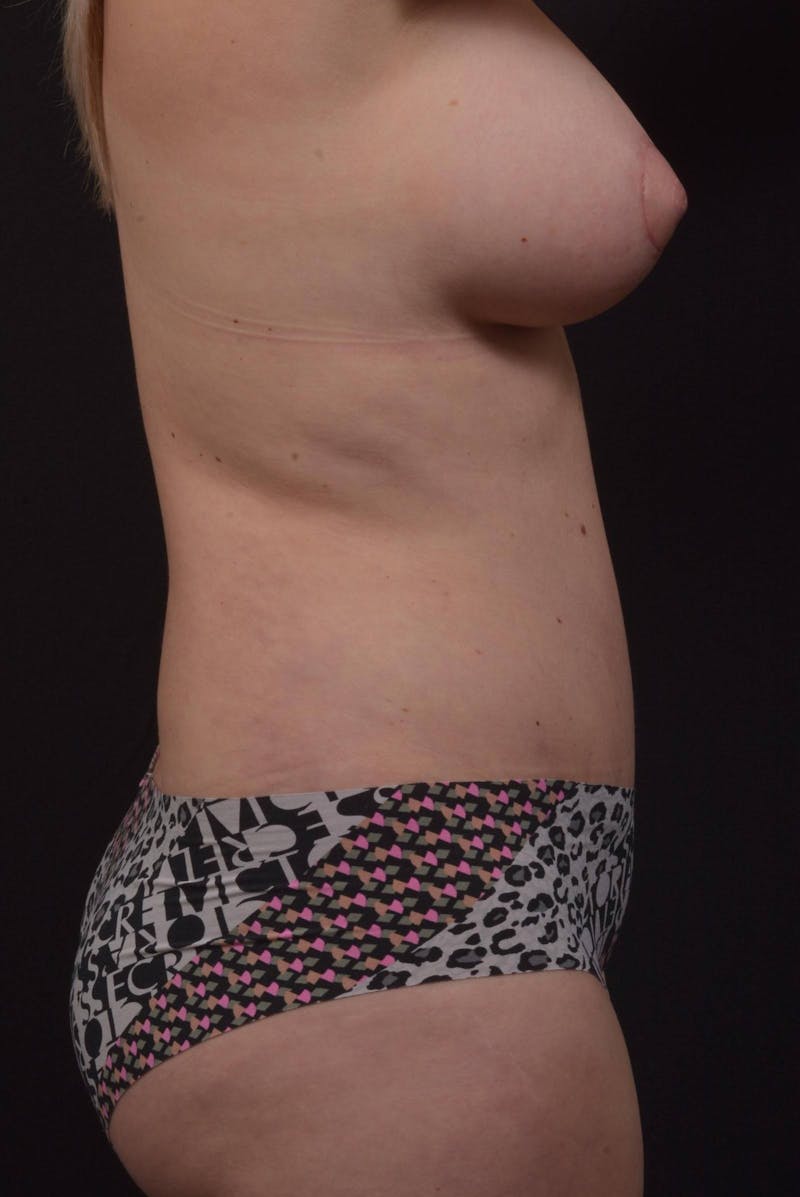 Mommy Makeover Before & After Gallery - Patient 415519 - Image 6