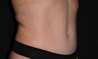 Abdominoplasty Before & After Gallery - Patient 239922 - Image 10