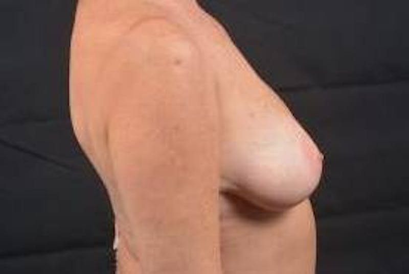 Breast Augmentation Mastopexy Before & After Gallery - Patient 787356 - Image 5