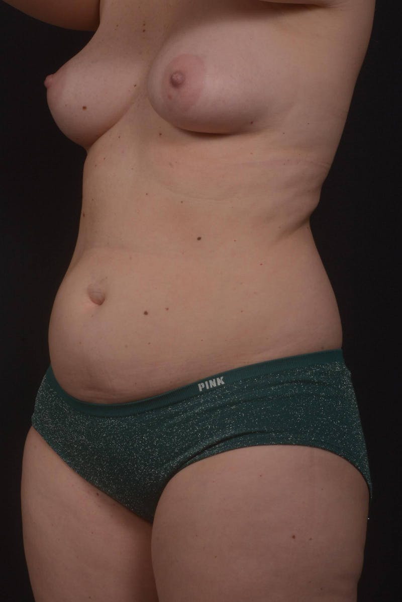 Mommy Makeover Before & After Gallery - Patient 415519 - Image 7