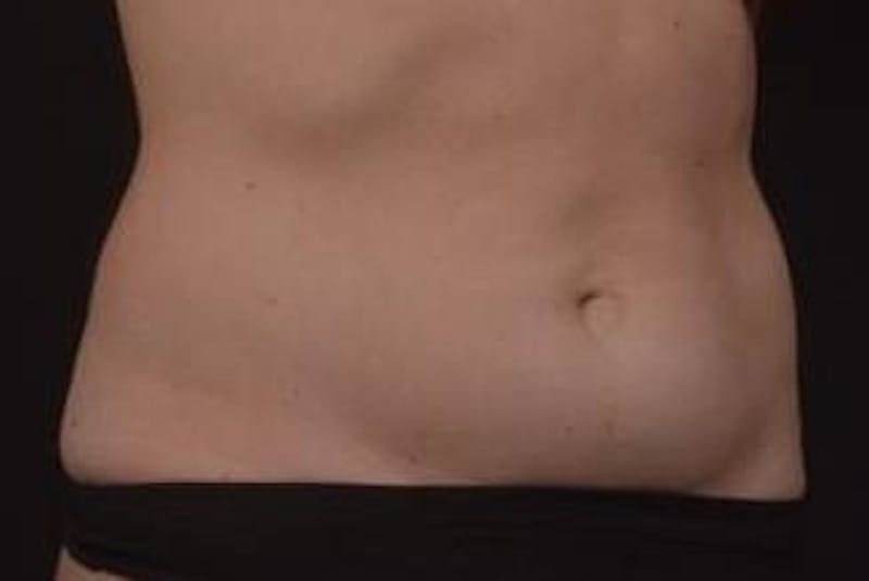 Abdominoplasty Before & After Gallery - Patient 271915 - Image 3