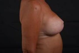Breast Augmentation Mastopexy Before & After Gallery - Patient 787356 - Image 6