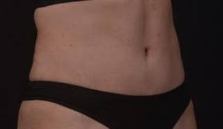 Abdominoplasty Before & After Gallery - Patient 271915 - Image 4