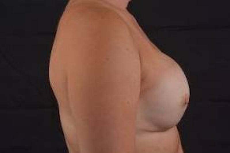 Immediate Breast Reconstruction – Nipple Sparing Before & After Gallery - Patient 269123 - Image 5