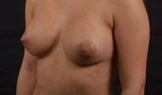 Aesthetic Breast Revision Before & After Gallery - Patient 172483 - Image 8