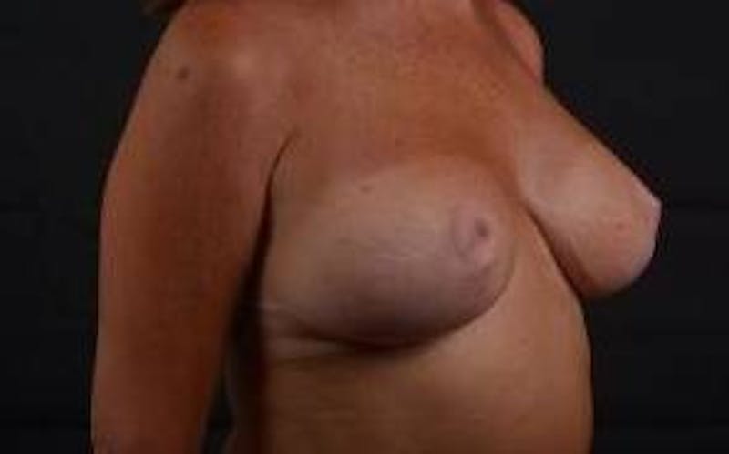 Breast Augmentation Mastopexy Before & After Gallery - Patient 787356 - Image 8