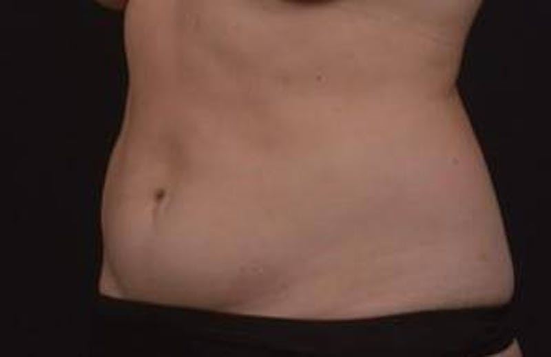 Abdominoplasty Before & After Gallery - Patient 271915 - Image 5