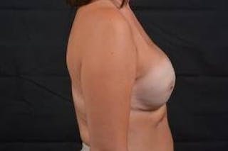 Immediate Breast Reconstruction – Nipple Sparing Before & After Gallery - Patient 269123 - Image 6