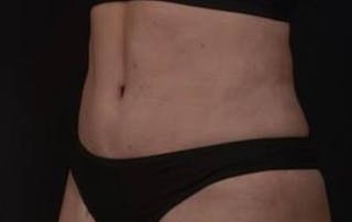 Abdominoplasty Before & After Gallery - Patient 271915 - Image 6
