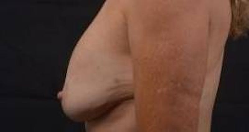 Breast Augmentation Mastopexy Before & After Gallery - Patient 124067 - Image 3