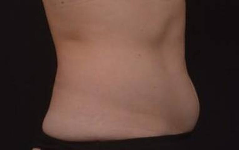 Abdominoplasty Before & After Gallery - Patient 271915 - Image 7