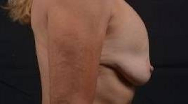 Breast Augmentation Mastopexy Before & After Gallery - Patient 124067 - Image 5