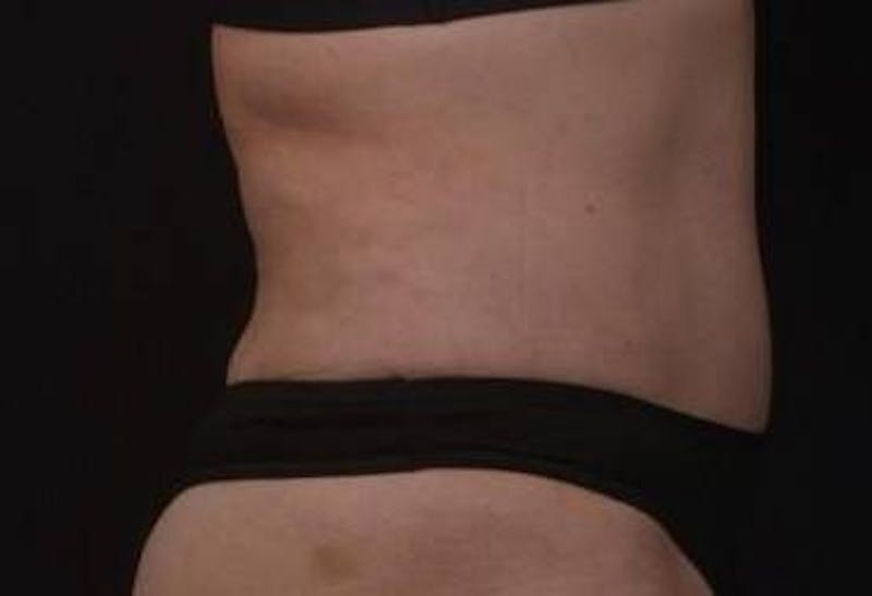 Abdominoplasty Before & After Gallery - Patient 271915 - Image 8
