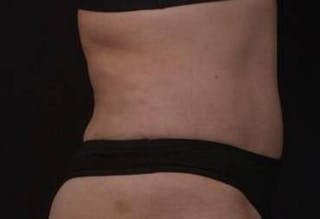 Abdominoplasty Before & After Gallery - Patient 271915 - Image 8