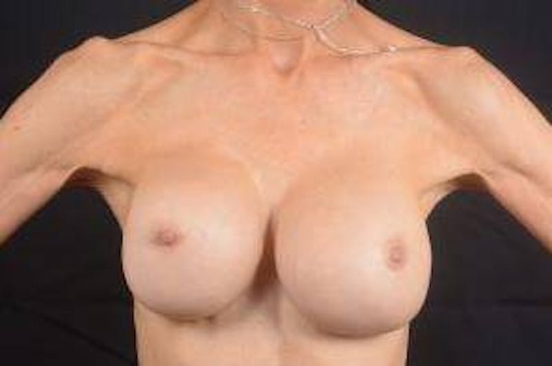 Aesthetic Breast Revision Before & After Gallery - Patient 300389 - Image 3