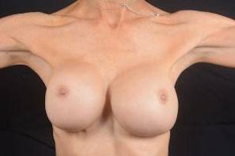 Aesthetic Breast Revision Before & After Gallery - Patient 300389 - Image 5