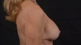 Breast Augmentation Mastopexy Before & After Gallery - Patient 124067 - Image 6