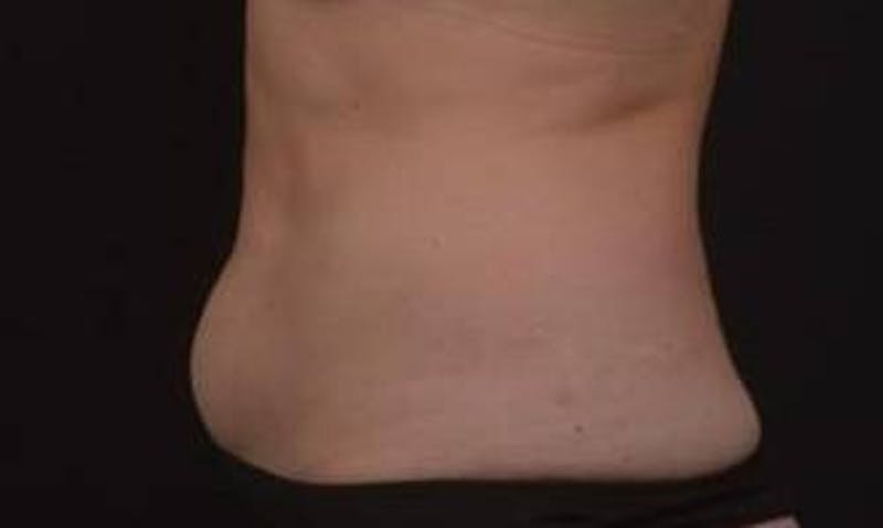Abdominoplasty Before & After Gallery - Patient 271915 - Image 9