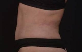 Abdominoplasty Before & After Gallery - Patient 271915 - Image 10