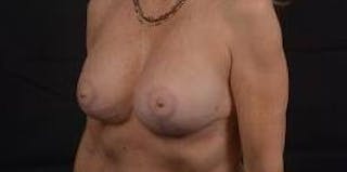 Breast Augmentation Mastopexy Before & After Gallery - Patient 124067 - Image 8