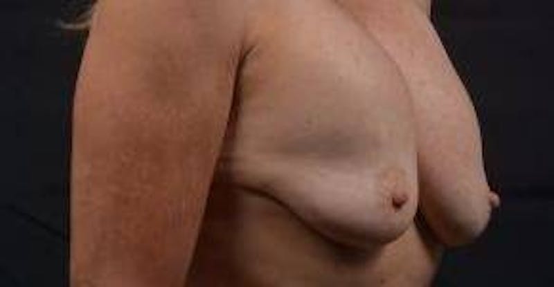 Breast Augmentation Mastopexy Before & After Gallery - Patient 124067 - Image 9