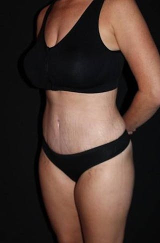 Abdominoplasty Before & After Gallery - Patient 856729 - Image 4