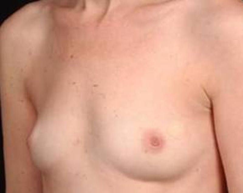 Immediate Breast Reconstruction – Nipple Sparing Before & After Gallery - Patient 275802 - Image 3